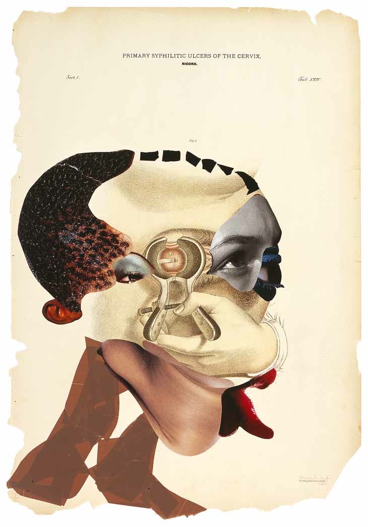 Wangechi Mutu, Primary Syphilitic Ulcers of the Cervix, 2005, collage on found medical illustration paper